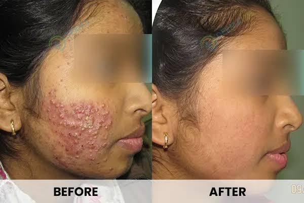 Advanced Acne Treatment