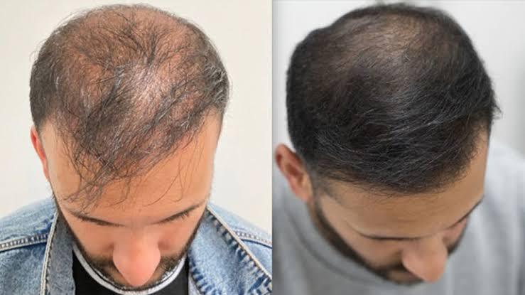 PRP Hair Therapy