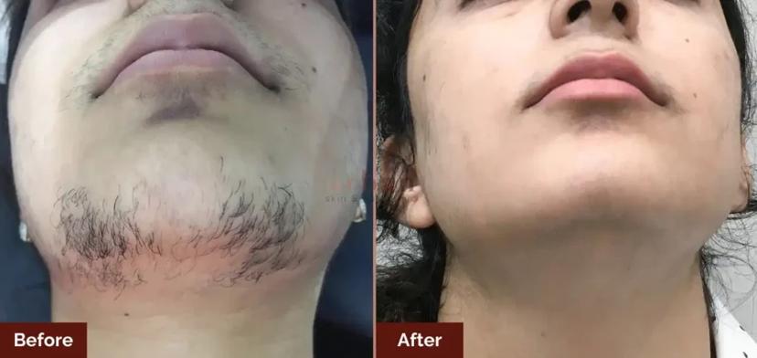 Permanent Hair Removal