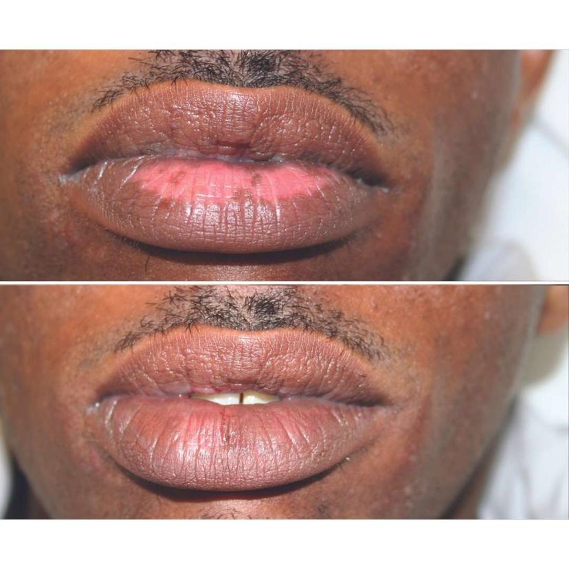 Micropigmentation