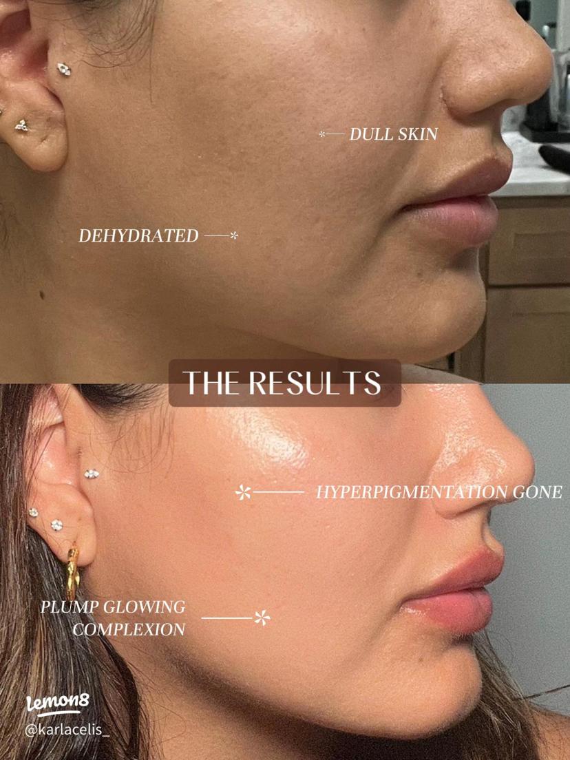 Skin Brightening